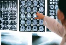 Cómo la depresión cambia la estructura del cerebro, según más de 3000 escaneos de imágenes posteriores
