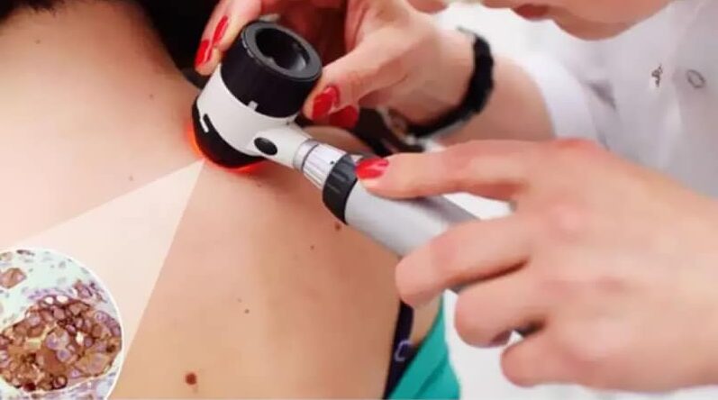 cirugía de Mohs tratar el cáncer de piel