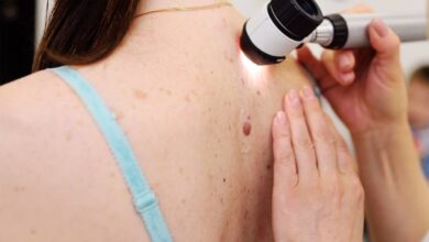 la cirugía de Mohs tratar el cáncer de piel